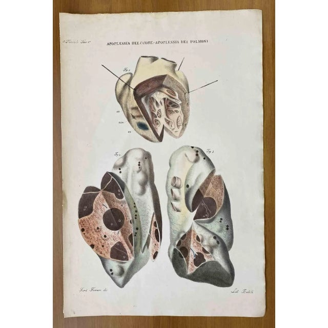 Apoplexy of the Heart and Lungs is a lithograph hand colored by Ottavio Muzzi for the edition of Antoine Chazal, Human...