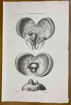 Ottavio Muzzi, Prostate Diseases, Lithograph, 1843