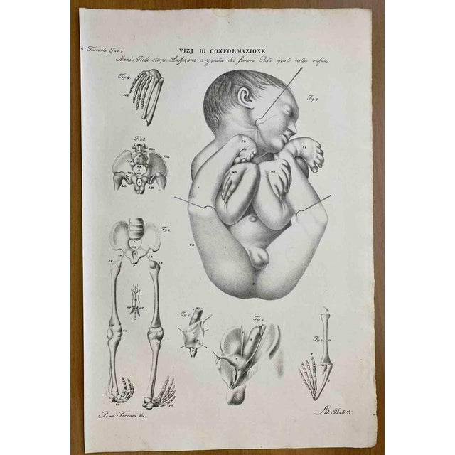 Conformation Defects is a lithograph hand colored by Ottavio Muzzi for the edition of Antoine Chazal, Human Anatomy,...