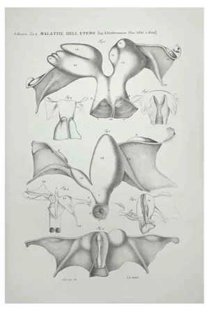 Ottavio Muzzi, Diseases of the Uterus, Lithograph, 1843