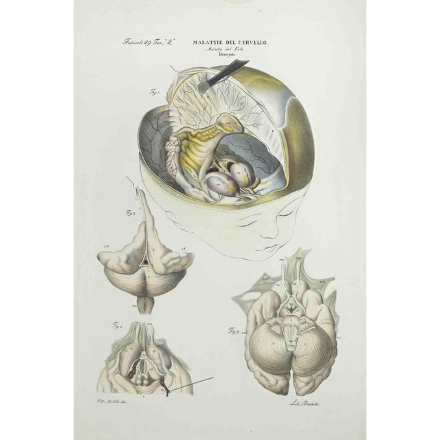Brain Diseases is a lithograph hand colored by Ottavio Muzzi for the edition of Antoine Chazal,Human Anatomy, Printers...
