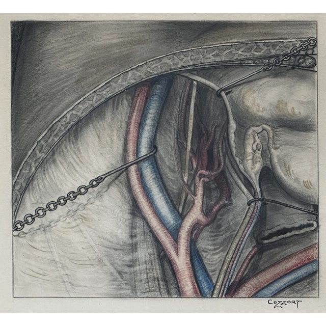 Antique 19th Century Surgical Mixed Media Drawing, Signed. Signed in the lower right corner. The drawing shows a surgery...