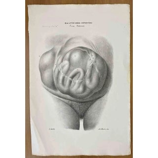 Ottavio Muzzi, Intestinal Diseases, Lithograph, 1843 For Sale