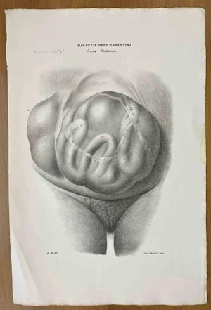 Ottavio Muzzi, Intestinal Diseases, Lithograph, 1843