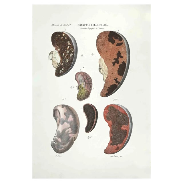 Ottavio Muzzi, Spleen Diseases, Lithograph, 1843 For Sale