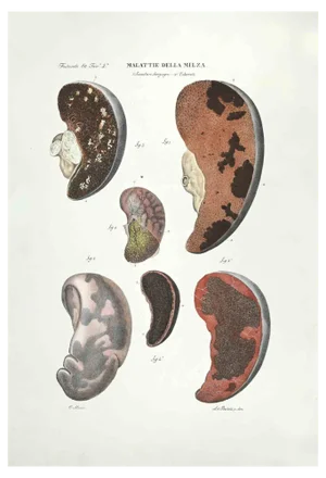 Ottavio Muzzi, Spleen Diseases, Lithograph, 1843
