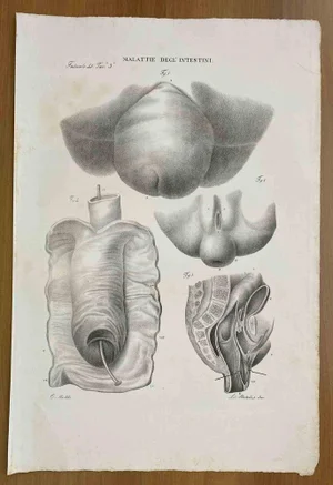 Ottavio Muzzi, Intestinal Diseases, Lithograph, 1843