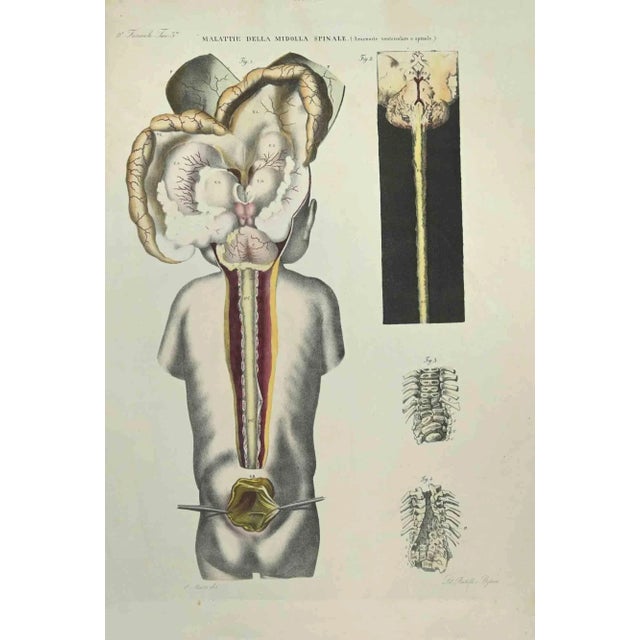 Spinal Cord Diseases is a lithograph hand colored by Ottavio Muzzi for the edition of Antoine Chazal, Human Anatomy,...
