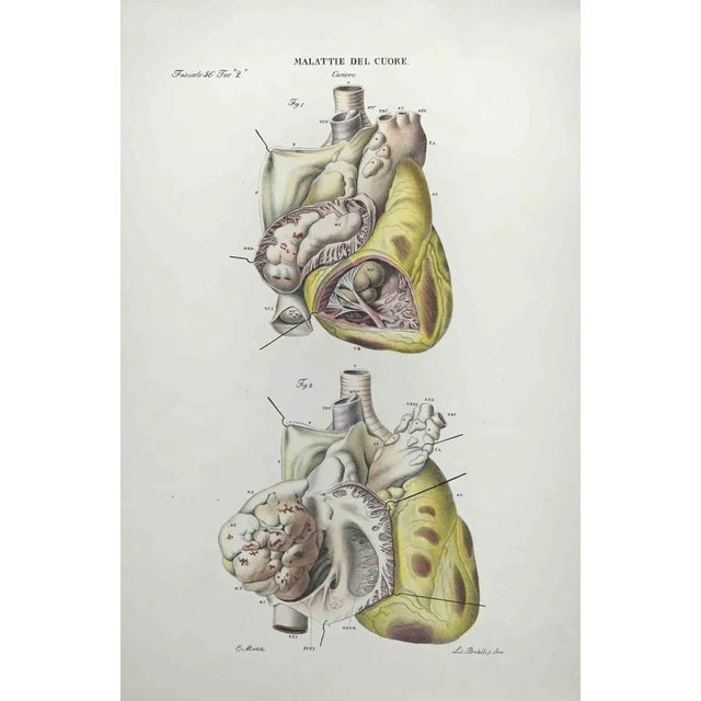 Ottavio Muzzi, Heart Disease, Lithograph, 1843 For Sale