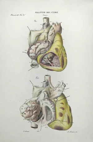 Ottavio Muzzi, Heart Disease, Lithograph, 1843