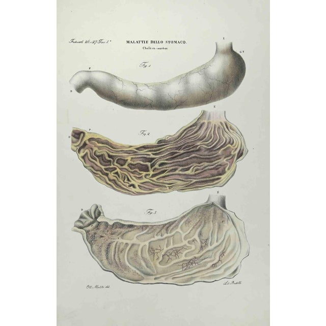 Stomach Diseases is a lithograph hand colored by Ottavio Muzzi for the edition of Antoine Chazal,Human Anatomy, Printers...