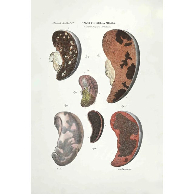 Spleen Diseases is a lithograph hand colored by Ottavio Muzzi for the edition of Antoine Chazal,Human Anatomy, Printers...