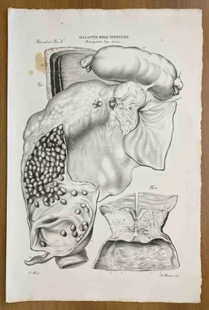 Ottavio Muzzi, Intestinal Diseases, Lithograph, 1843
