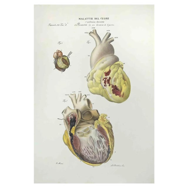 Ottavio Muzzi, Heart Diseases, Lithograph, 1843 For Sale