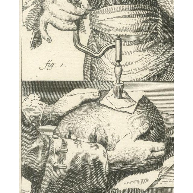 18th Century Antonio Baratti, Trepanning the Skull and Cautery Irons, Diderot Chirurgie Plate Xvii, 1772, Engraving For Sale - Image 5 of 8