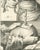 18th Century Antonio Baratti, Trepanning the Skull and Cautery Irons, Diderot Chirurgie Plate Xvii, 1772, Engraving For Sale - Image 5 of 8