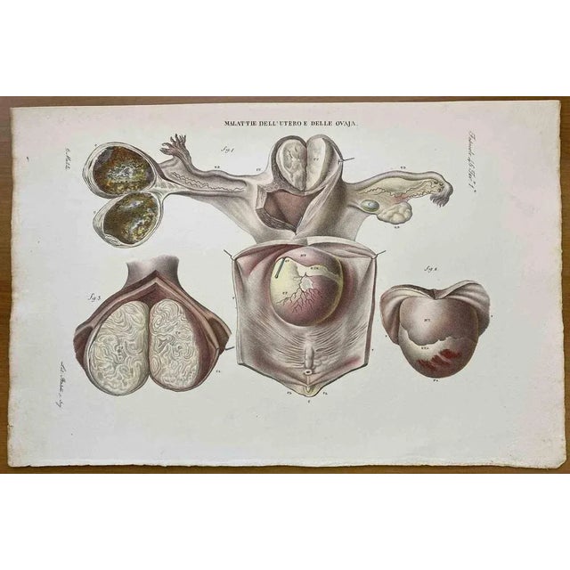 Diseases of Uterus is a lithograph hand colored by Ottavio Muzzi for the edition of Antoine Chazal, Human Anatomy,...