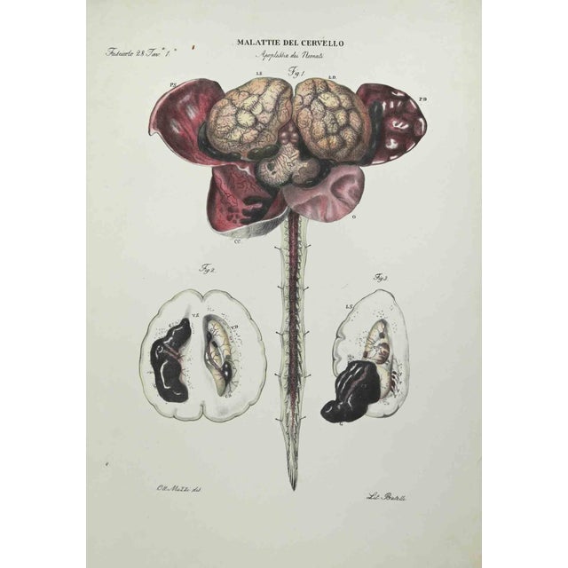Brain Diseases is a lithograph hand colored by Ottavio Muzzi for the edition of Antoine Chazal,Human Anatomy, Printers...
