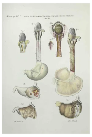 Ottavio Muzzi, Mouth, Esophagus and Stomach Diseases, Lithograph, 1843