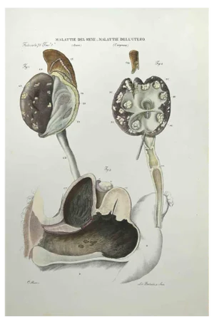 Ottavio Muzzi, Kidney Diseases & Uterus Diseases, Lithograph, 1843