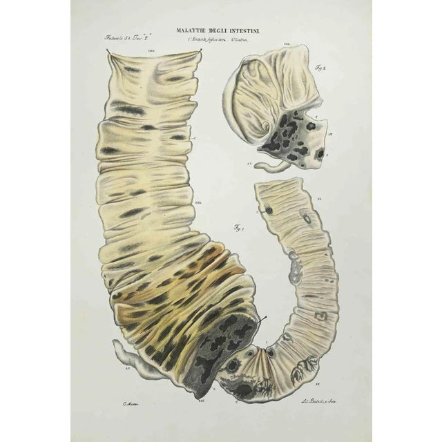 Diseases of the Intestines is a lithograph hand colored by Ottavio Muzzi for the edition of Antoine Chazal,Human Anatomy,...