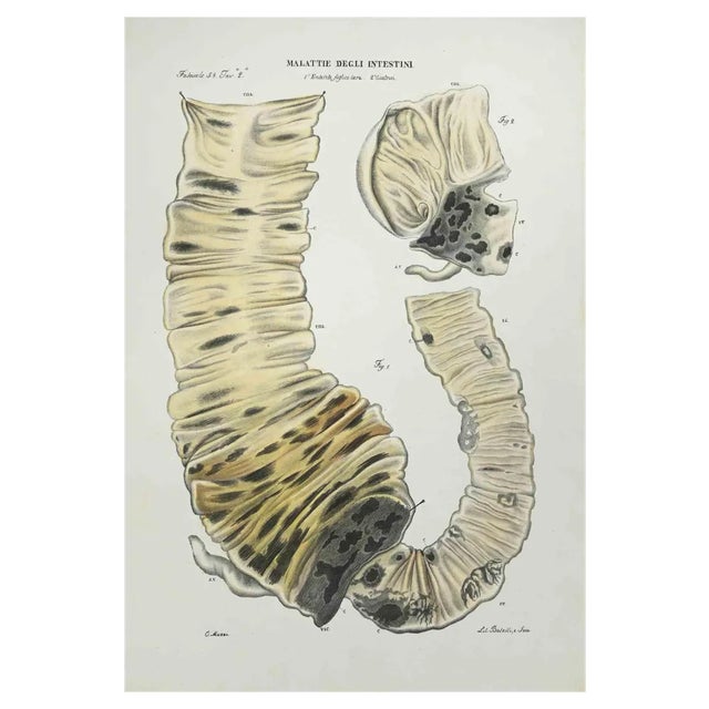 Ottavio Muzzi, Diseases of the Intestines, Lithograph, 1843 For Sale