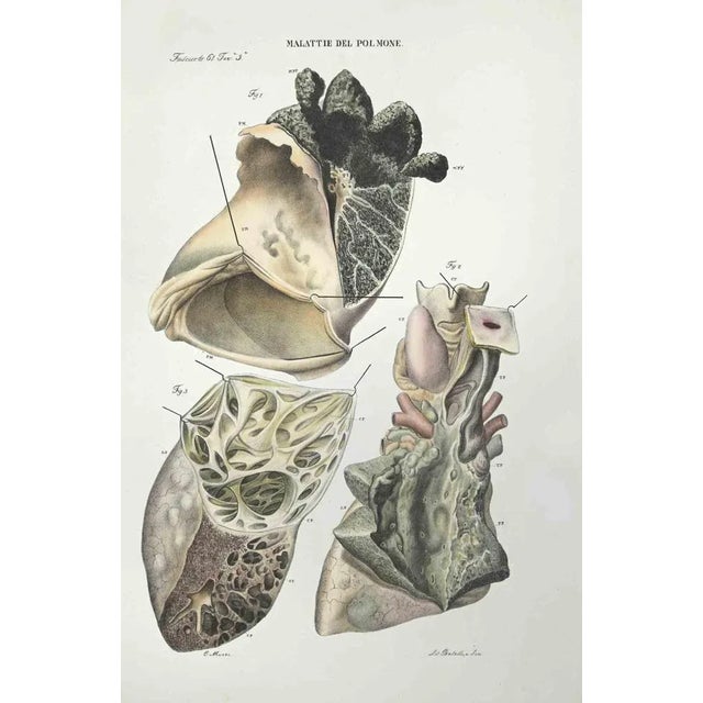 Lung Diseases is a lithograph hand colored by Ottavio Muzzi for the edition of Antoine Chazal, Human Anatomy, Printers...