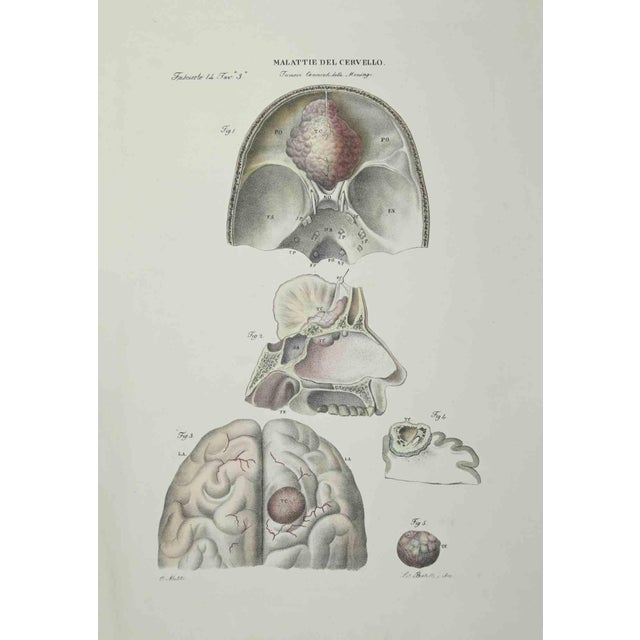 Brain Diseases is a lithograph hand colored by Ottavio Muzzi for the edition of Antoine Chazal, Human Anatomy, Printers...
