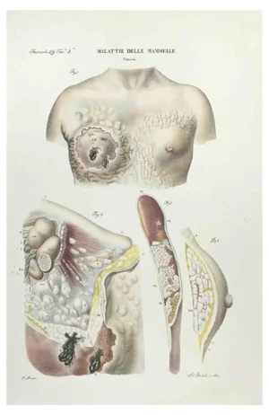 Ottavio Muzzi, Breast Diseases, Lithograph, 1843