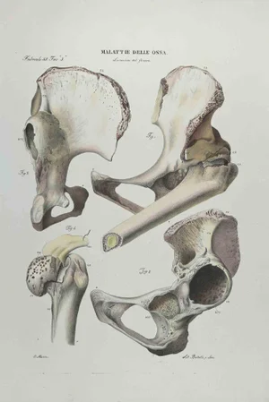 Ottavio Muzzi, Bone Disease, Lithograph, 1843