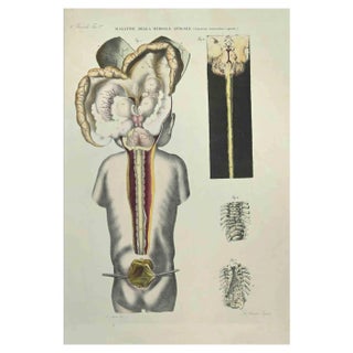 Ottavio Muzzi, Spinal Cord Diseases, Lithograph, 1843 For Sale
