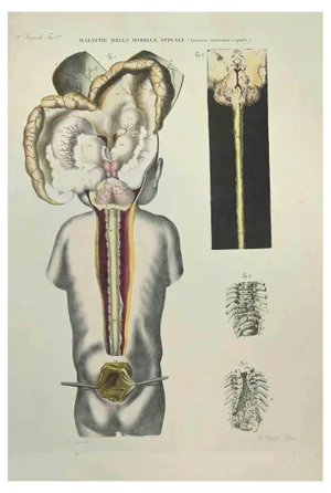 Ottavio Muzzi, Spinal Cord Diseases, Lithograph, 1843