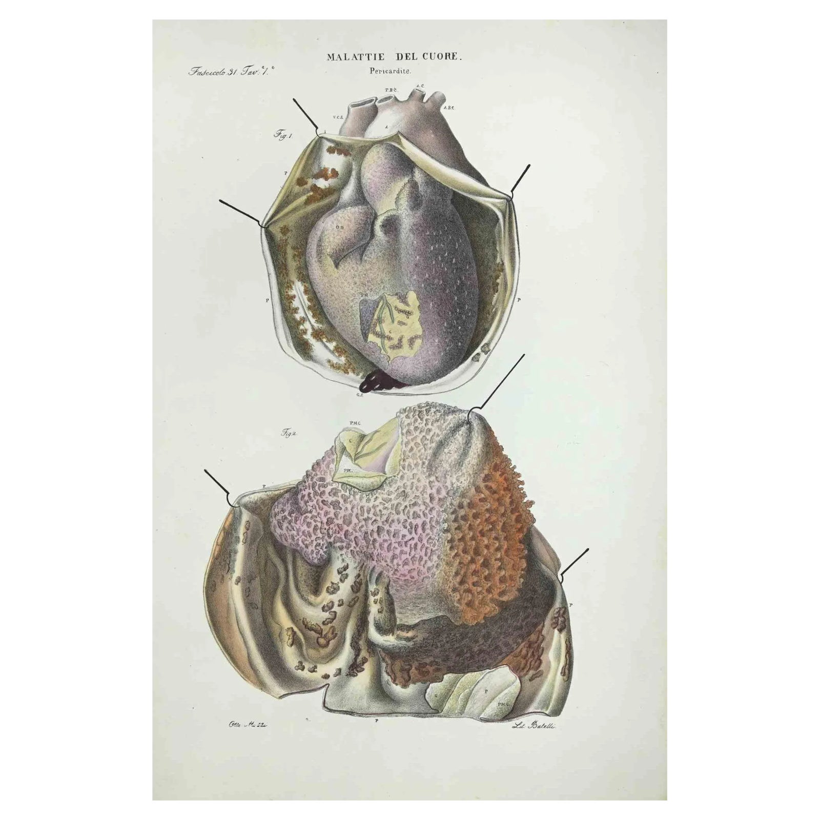 Ottavio Muzzi, Heart Diseases, Lithograph, 1843 | Chairish
