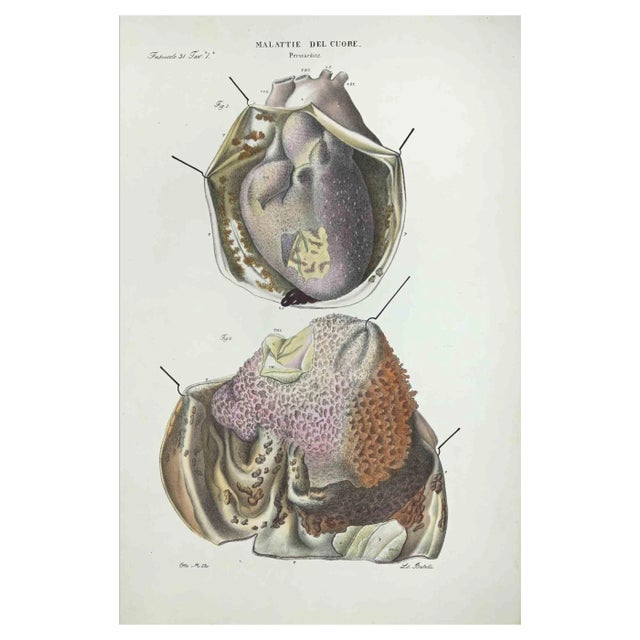 Ottavio Muzzi, Heart Diseases, Lithograph, 1843 For Sale