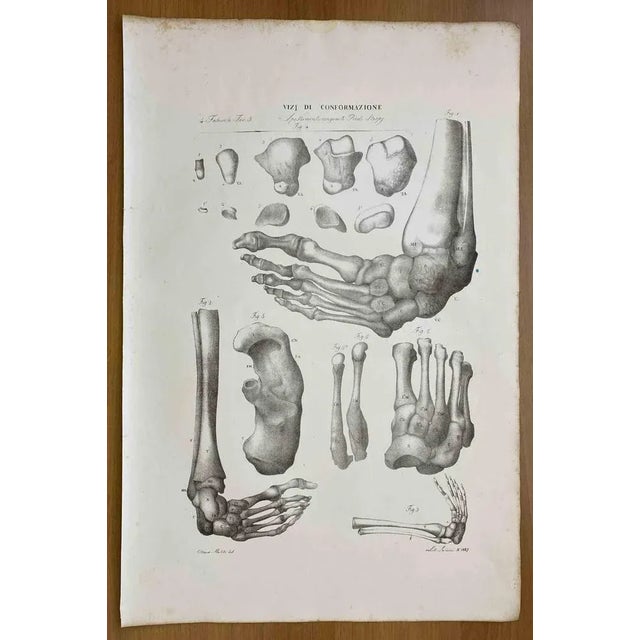 Conformation Defects is a lithograph hand colored by Ottavio Muzzi for the edition of Antoine Chazal, Human Anatomy,...