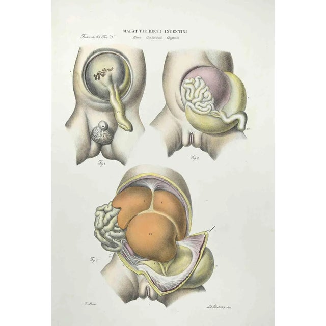 Diseases of the Intestines is a lithograph hand colored by Ottavio Muzzi for the edition of Antoine Chazal,Human Anatomy,...