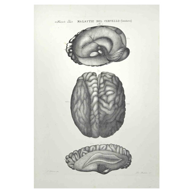 Ottavio Muzzi, Brain Diseases, Lithograph, 1843 For Sale