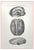Ottavio Muzzi, Brain Diseases, Lithograph, 1843 For Sale