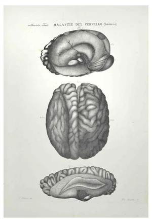 Ottavio Muzzi, Brain Diseases, Lithograph, 1843