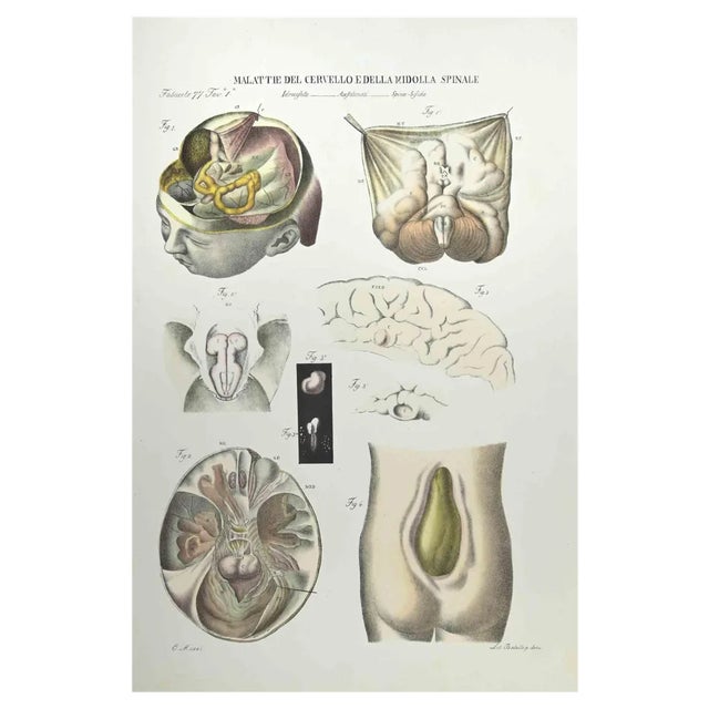 Ottavio Muzzi, Diseases of the Brain and Spinal Cord, Lithograph, 1843 For Sale