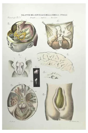 Ottavio Muzzi, Diseases of the Brain and Spinal Cord, Lithograph, 1843