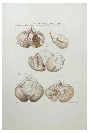 Ottavio Muzzi, Diseases of the Cerebellum, Lithograph, 1843
