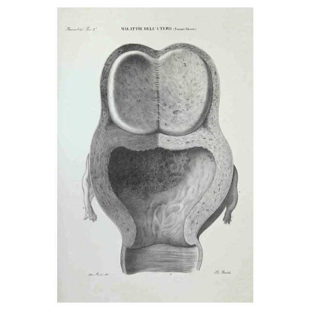 Ottavio Muzzi, Uterus Diseases, Lithograph, 1843 For Sale