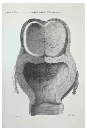 Ottavio Muzzi, Uterus Diseases, Lithograph, 1843