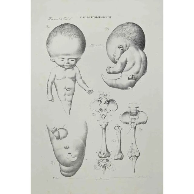 Conformation Defects is a lithograph realized by Ottavio Muzzi for the edition of Antoine Chazal, Human Anatomy, Printers...