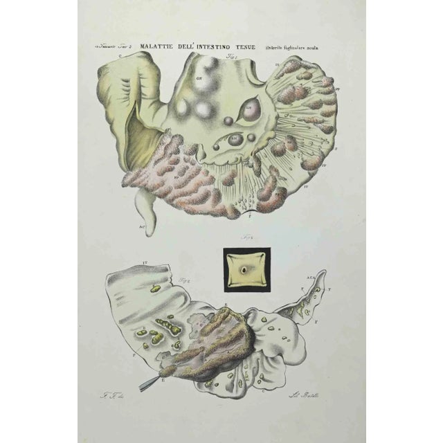 Small Intestine Diseases is a lithograph hand colored by Ottavio Muzzi for the edition of Antoine Chazal, Human Anatomy,...
