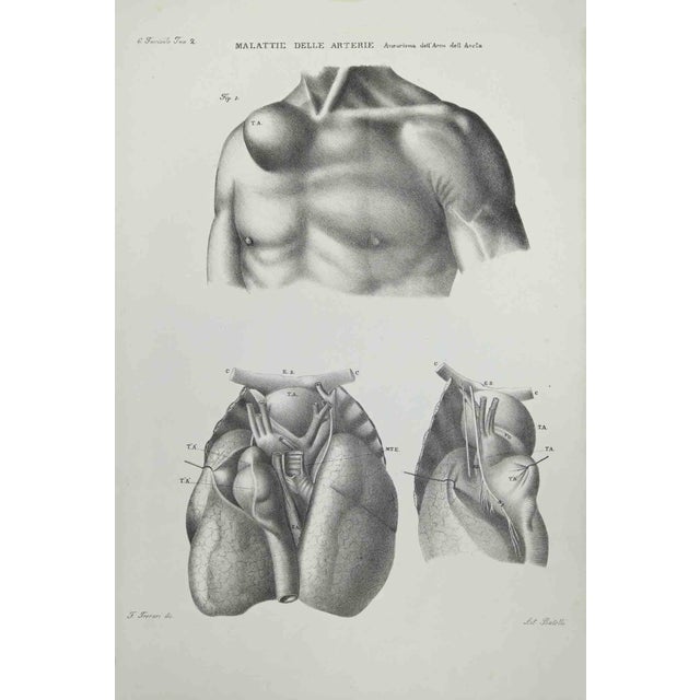 Diseases of the Arteries is a lithograph hand colored by Ottavio Muzzi for the edition of Antoine Chazal, Human Anatomy,...