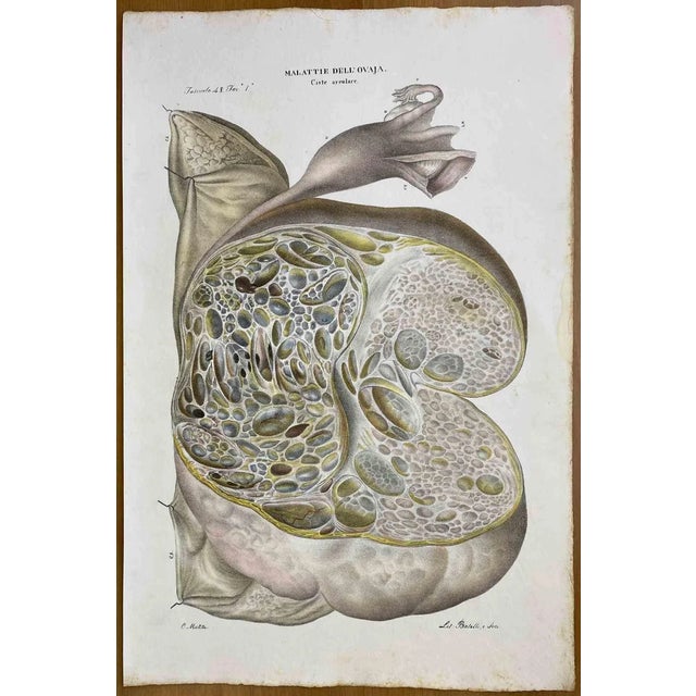 Ottavio Muzzi, Diseases of the Ovary, Lithograph, 1843 For Sale