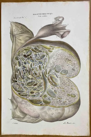 Ottavio Muzzi, Diseases of the Ovary, Lithograph, 1843