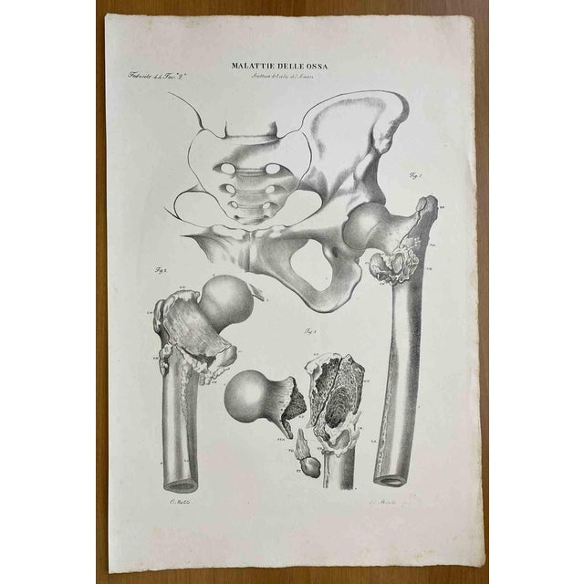 Ottavio Muzzi, Bone Diseases, Lithograph, 1843 For Sale